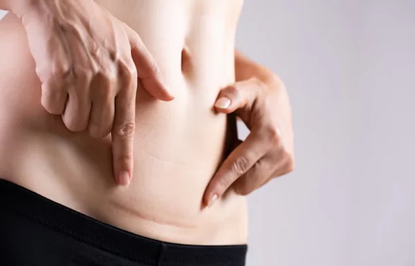 Cesarean Section