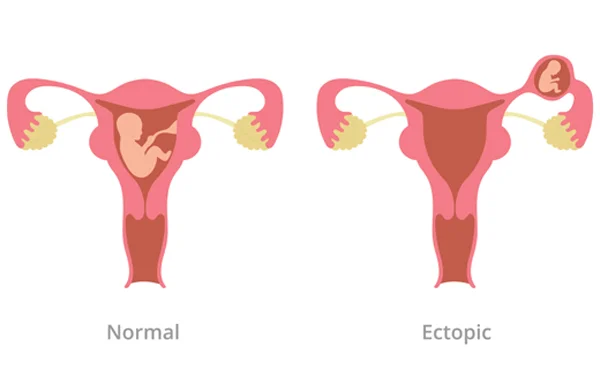 Ectopic Pregnancy