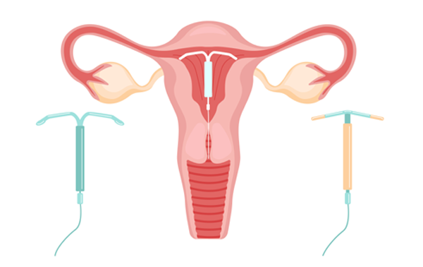 IUCD  Insertion