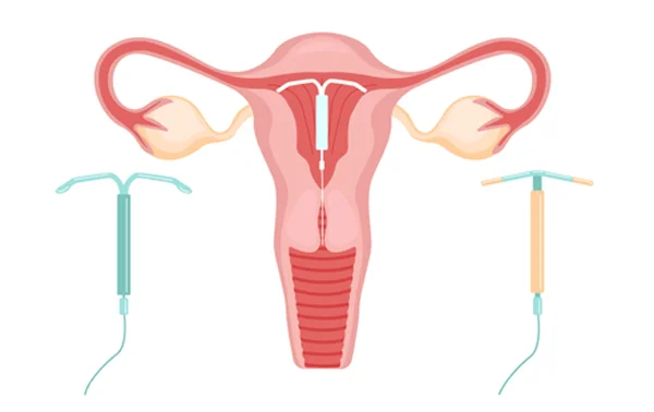 IUCD Insertion