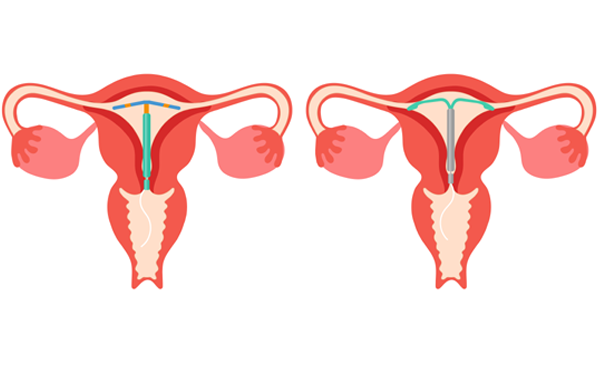 IUCD Removal