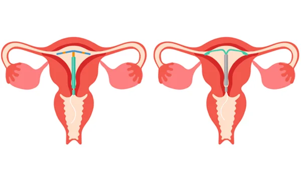 IUCD Removal
