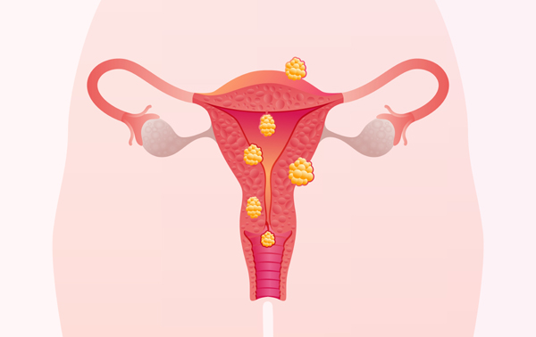 Fibroids Treatment