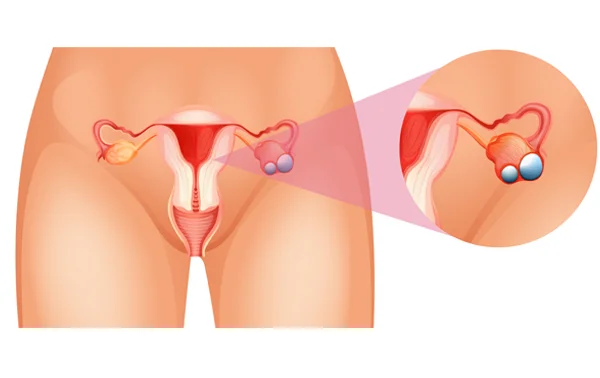 Ovarian Cysts