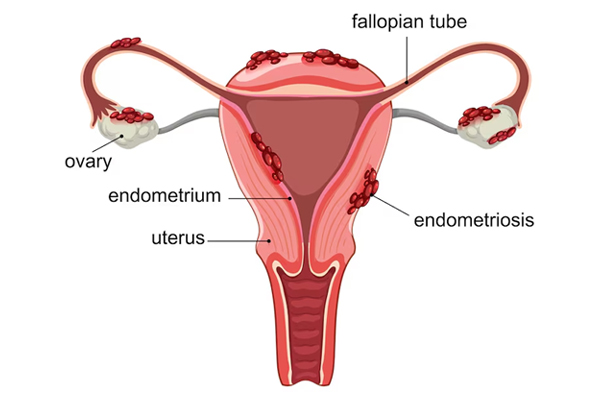 Hysterectomy