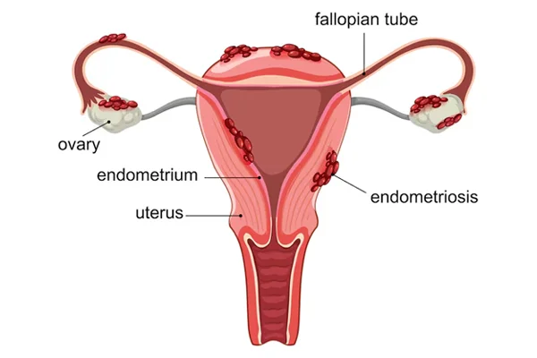 Hysterectomy