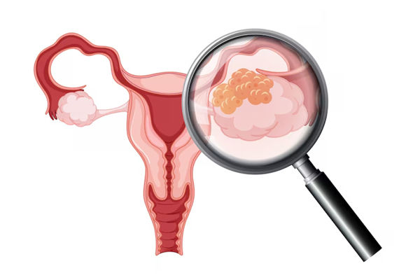 Ovarian Cystectomy
