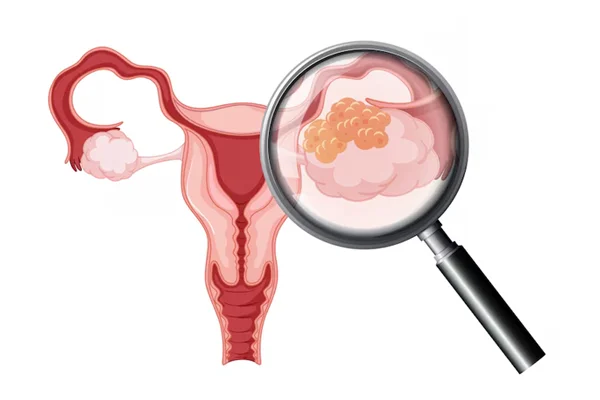 Ovarian Cystectomy