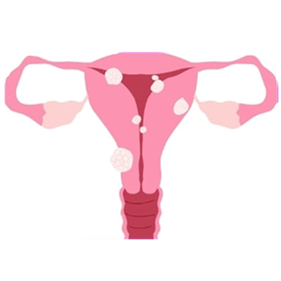 Fibroids Treatment